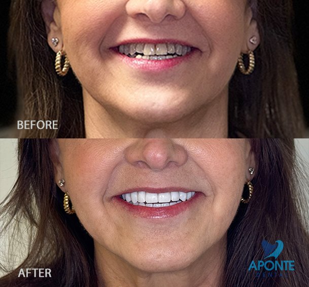 Patient transformation before and after digital Smile Design at Aponte Dental Miami