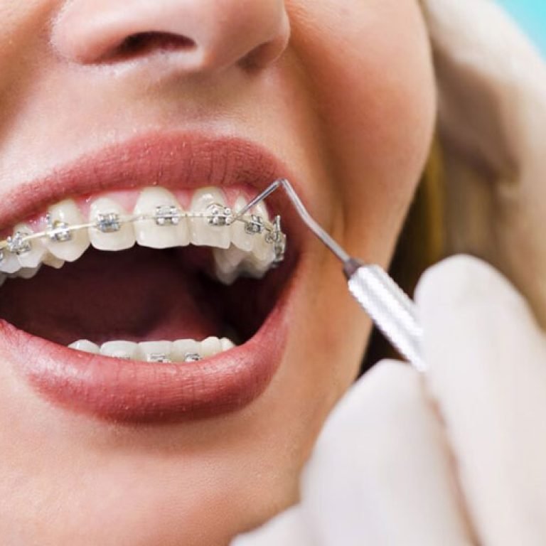 Orthodontic braces treatment at Aponte Dental Corp Miami