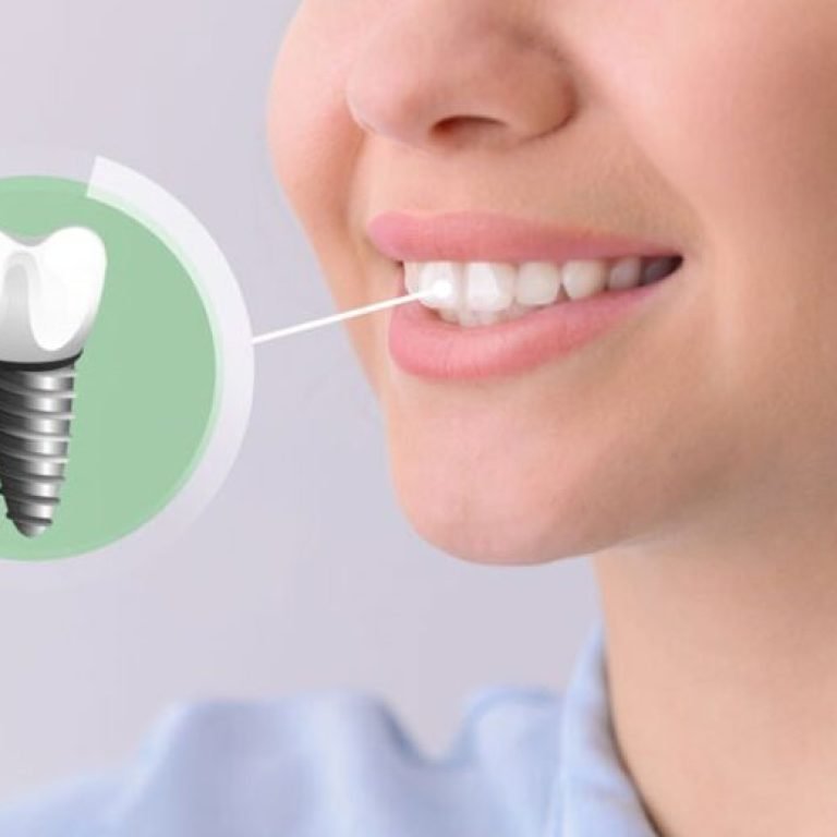 Dental implants treatment at Aponte Dental Corp in Miami Florida