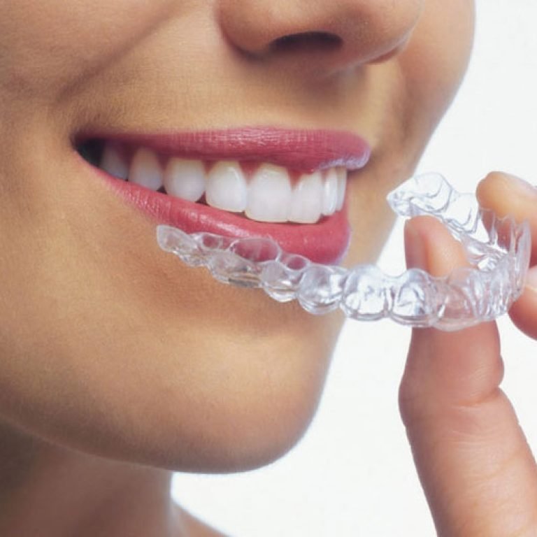 Invisalign clear aligners treatment at Aponte Dental Corp in Miami