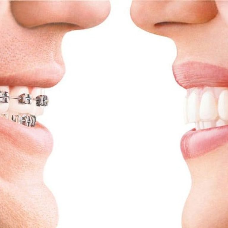 Orthodontic treatment with braces and clear aligners at Aponte Dental Corp Miami