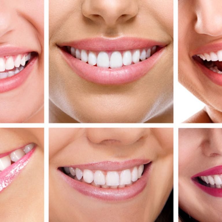 Smile design preview with digital simulation in Miami